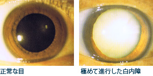 白内障