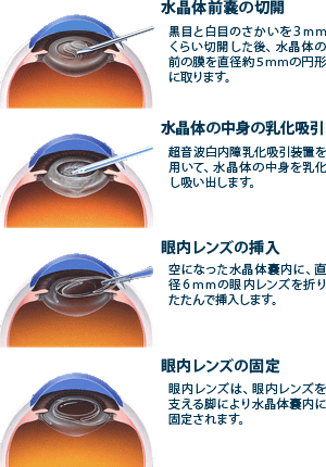 白内障の図解