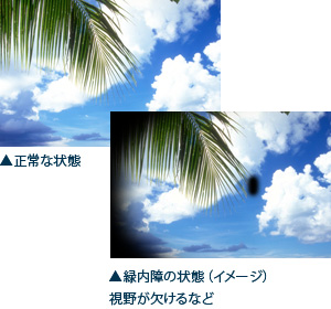 緑内障